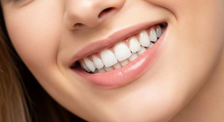 تفاوت لمینت و کامپوزیت دندان