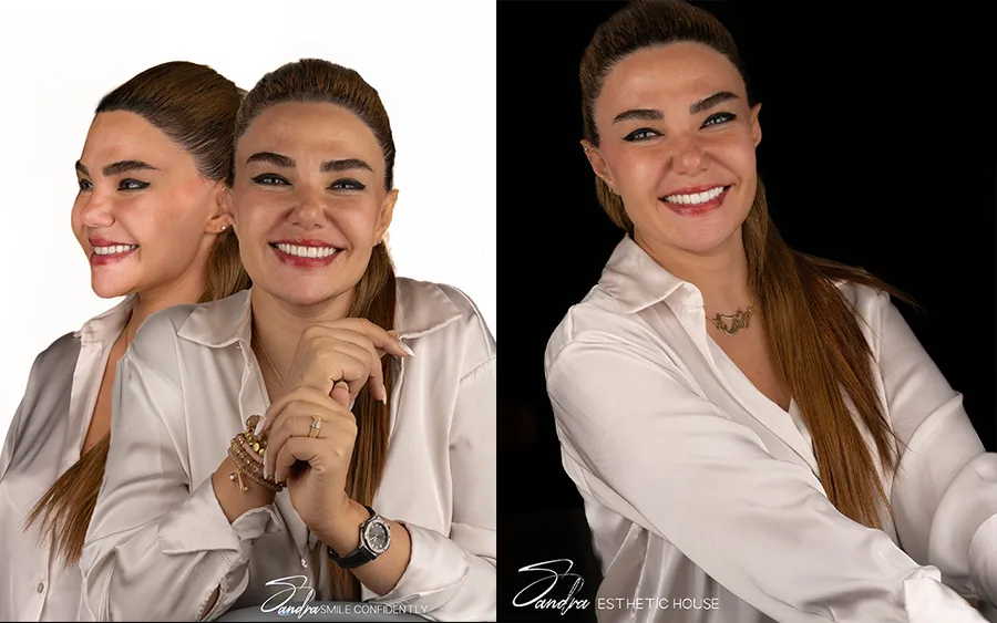 مراحل لمینت دندان 
