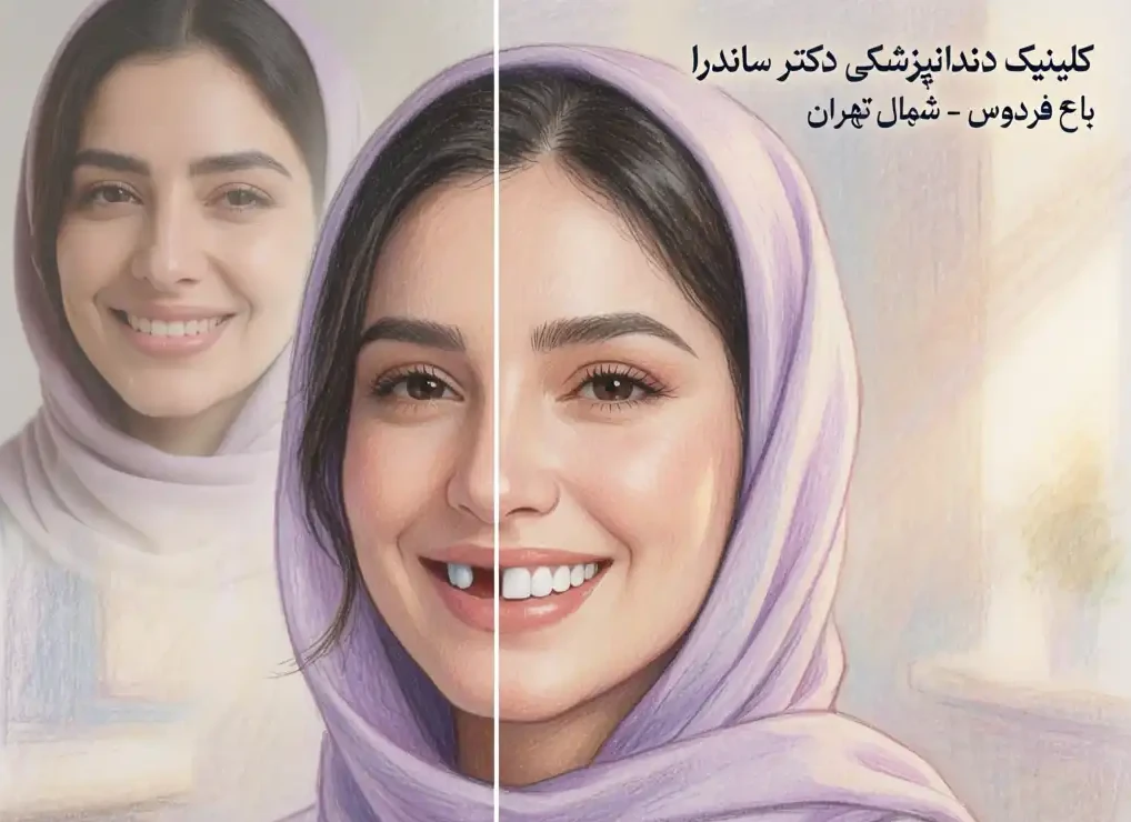 ایمپلنت دندان جلو