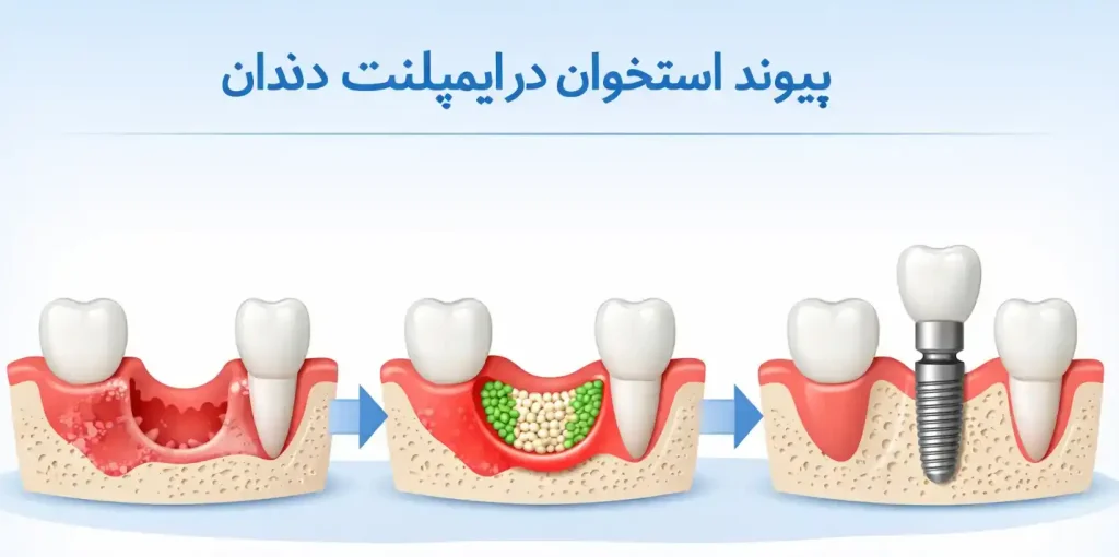 پیوند استخوان در ایمپلنت دندان