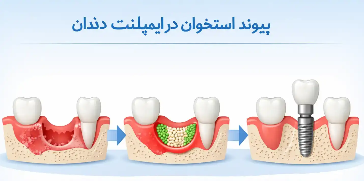 پیوند استخوان در ایمپلنت دندان